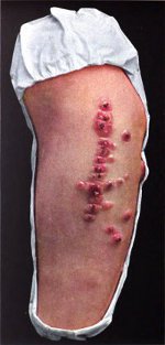 Multiple anthrax lesions.